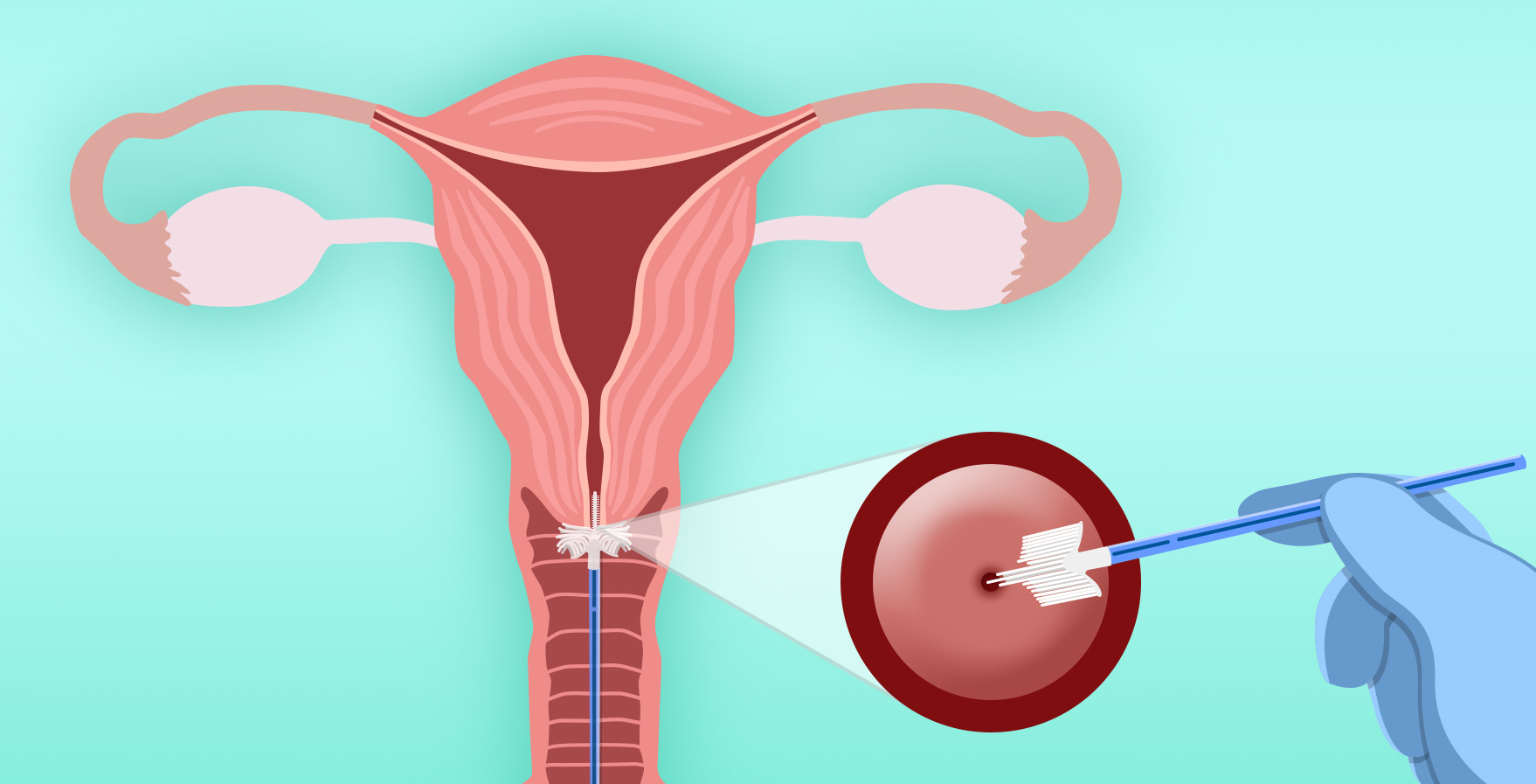 Clarice, personagem para campanha BD Brasil sobre câncer de mama (via GPeS)